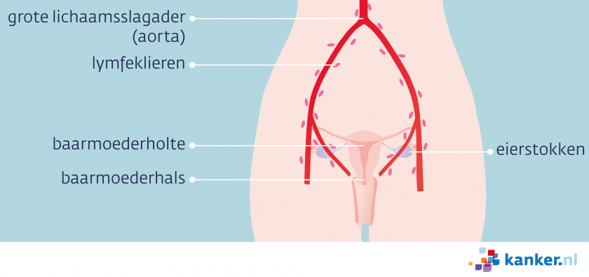 Als baarmoederhalskanker uitzaait is dat meestal naar de lymfeklieren in het bekken en langs de aorta.