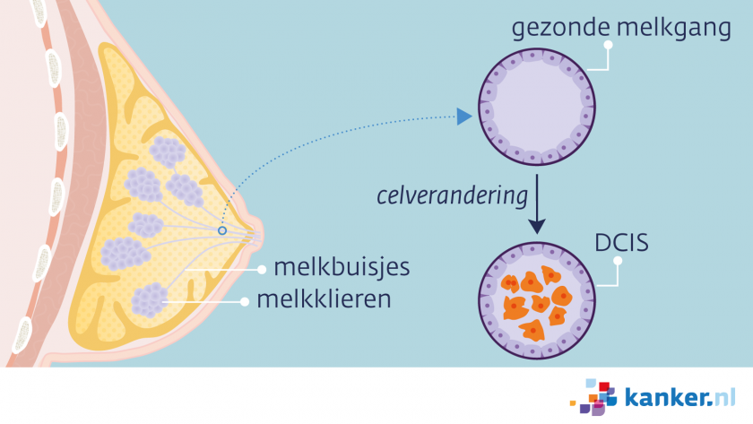 Bij DCIS zitten er kwaadaardige cellen in de melkbuisjes (melkgangen) van de borst.
