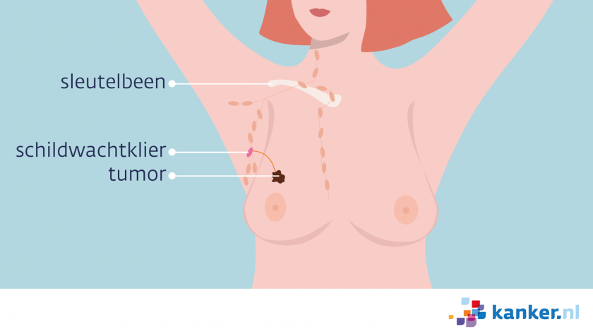 De schildwachtklier (poortwachterklier) kan op meerdere plekken rond de borst zitten.