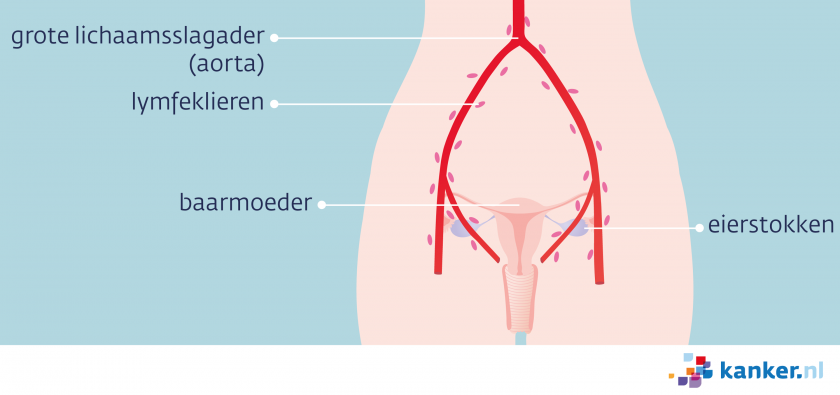 Meestal zitten de uitzaaiingen in de lymfeklieren in het kleine bekken en rond de grote lichaamsslagader (aorta).