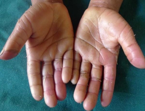 Besmettelijke ziekte Interactie Memoriseren Hand- en voetsyndroom: wat is het en wat kun je er aan doen? | Kanker.nl