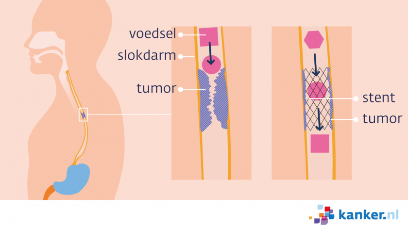 Een stent houdt de slokdarm open op de plek van de tumor zodat er drinken en fijn voedsel doorheen kan.