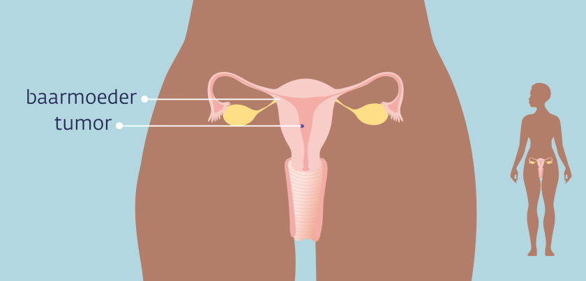 Bij baarmoederkanker zit er een tumor in het slijmvlies van de baarmoeder.
